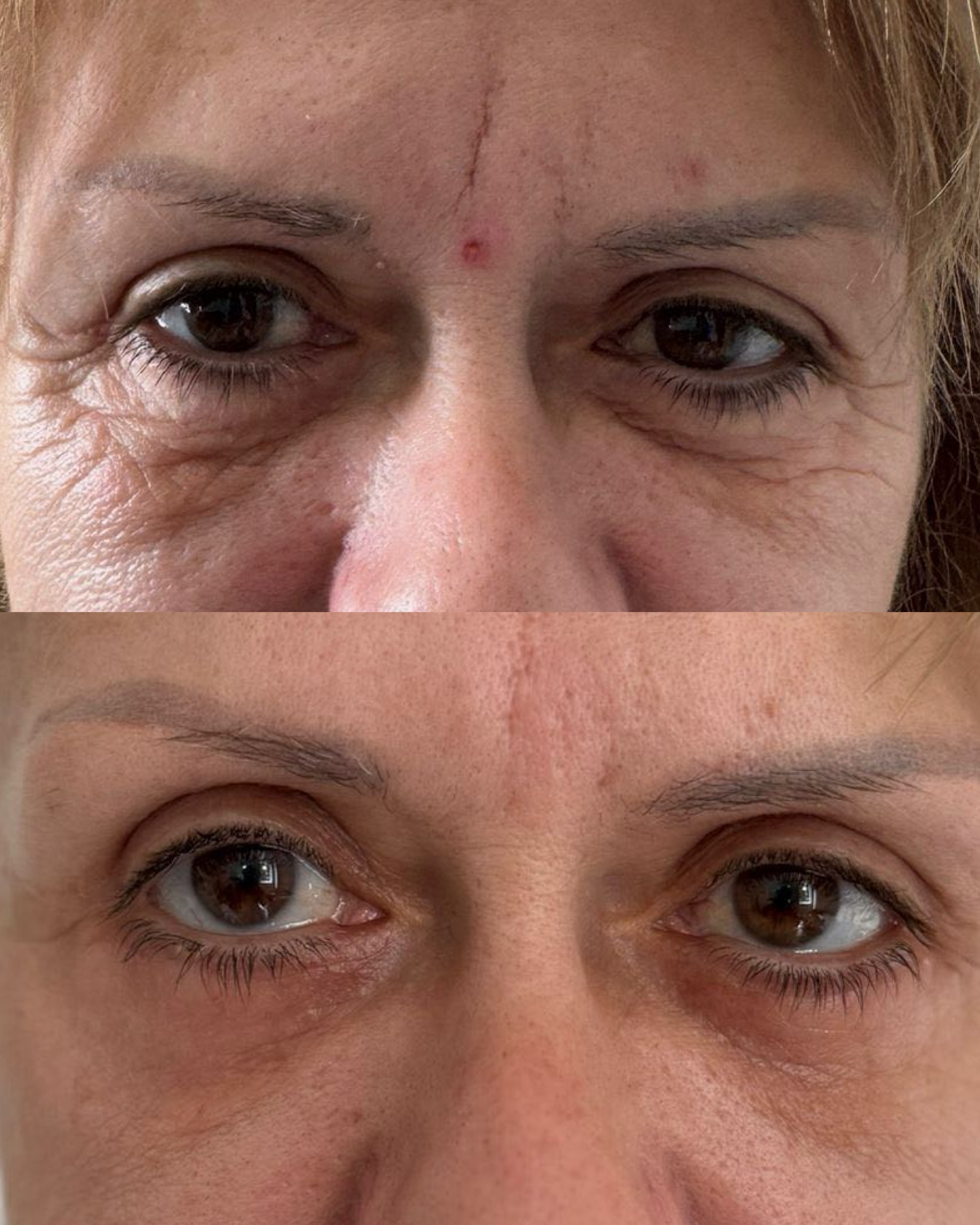 Spodní blefaroplastika 